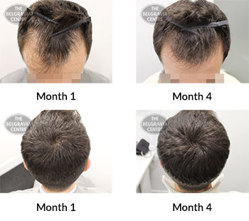 alert male pattern hair loss the belgravia centre 392073 29 04 2020