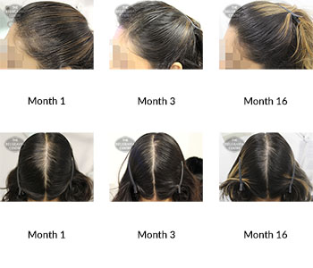 alert female pattern hair loss and diffuse hair loss the belgravia centre 373474 04 05 2020