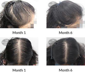 alert female pattern hair loss the belgravia centre 396767 29 07 2020