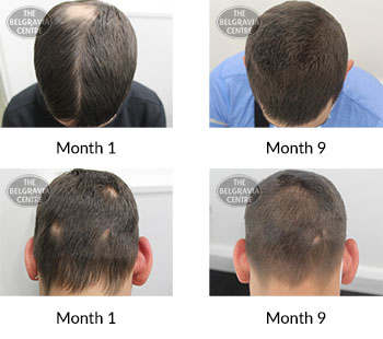 alert male pattern hair loss and alopecia areata the belgravia centre 392781 10 08 2020