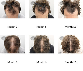 alert male pattern hair loss the belgravia centre 386329 17 08 2020