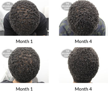 alert male pattern hair loss the belgravia centre 393968 25 08 2020
