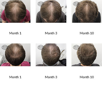 alert male pattern hair loss the belgravia centre 392820 10 09 2020