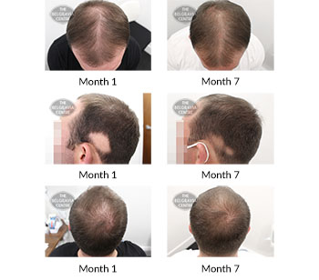 Success Story Alert! New Men's Hair Loss Treatment Entry