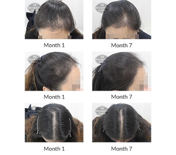 alert female pattern hair loss the belgravia centre 397045 06 10 2020
