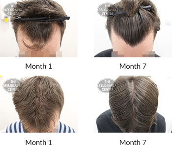 alert male pattern hair loss the belgravia centre 397666 06 10 2020 1