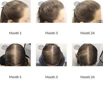 alert female pattern hair loss the belgravia centre 371139 09 10 2020