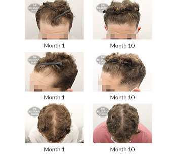 alert male pattern hair loss the belgravia centre 394872 13 10 2020