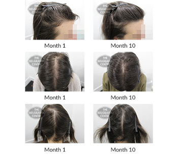 alert female pattern hair loss and hair breakage the belgravia centre 394608 13 10 2020