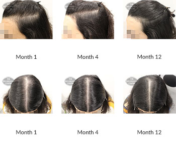 alert female pattern hair loss the belgravia centre 391021 20 10 2020