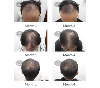 alert male pattern hair loss the belgravia centre 387163 21 10 2020