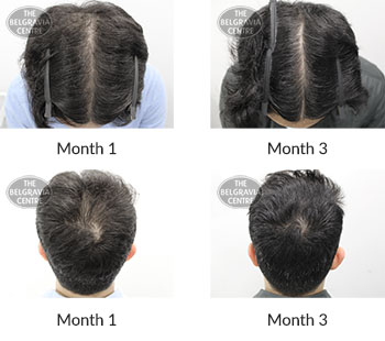 alert male pattern hair loss the belgravia centre 404285 21 10 2020
