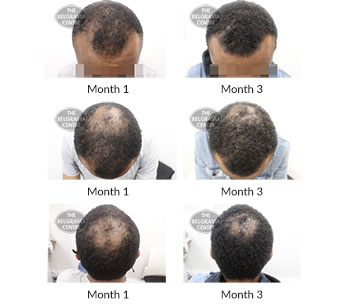 alert male pattern hair loss the belgravia centre 405966 23 10 2020