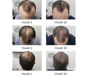 alert male pattern hair loss the belgravia centre 394340 26 10 2020