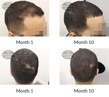alert male pattern hair loss the belgravia centre 395767 28 10 2020