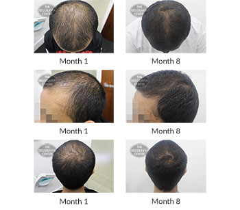 alert male pattern hair loss the belgravia centre 397286 30 10 2020