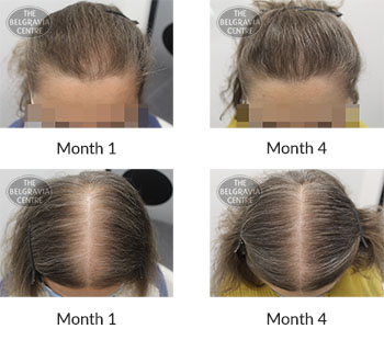 alert female pattern hair loss the belgravia centre 403948 05 11 2020