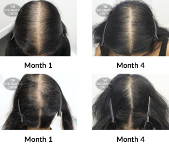 alert female pattern hair loss and diffuse thinning the belgravia centre 382439 02 10 2019