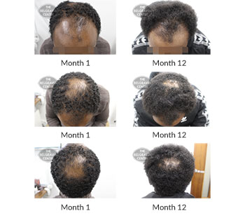 alert male pattern hair loss the belgravia centre 390702 23 11 2020