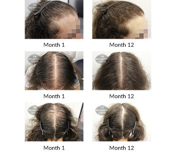 alert male pattern hair loss the belgravia centre 392821 30 11 2020