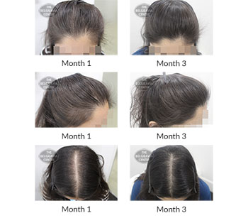 alert female pattern hair loss the belgravia centre 408039 03 12 2020
