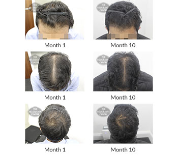 alert male pattern hair loss the belgravia centre 397581 03 12 2020 1