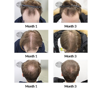 alert male pattern hair loss the belgravia centre 382322 09 12 2020