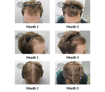 alert male pattern hair loss the belgravia centre 397369 15 12 2020