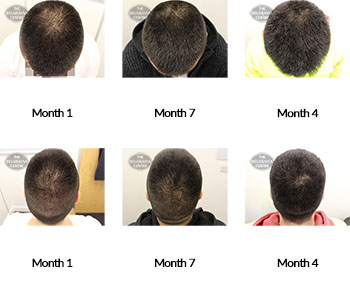 alert male pattern hair loss the belgravia centre 339281 17 12 2020