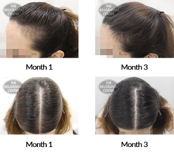 alert female pattern hair loss and diffuse hair loss the belgravia centre 409305 18 12 2020