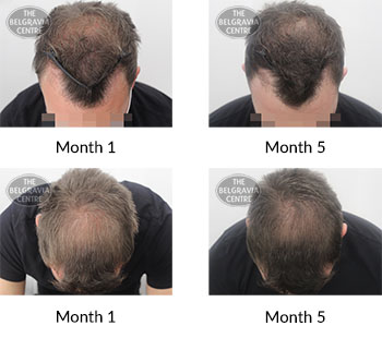 alert male pattern hair loss the belgravia centre 405198 28 12 2020