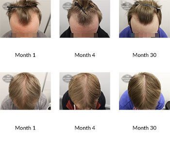 alert male pattern hair loss the belgravia centre 365258 05 01 2021