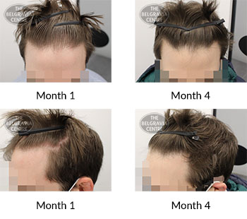 alert male pattern hair loss the belgravia centre 298918 06 01 2020