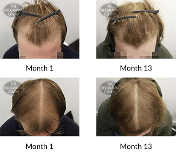 alert male pattern hair loss the belgravia centre 393616 14 01 2021