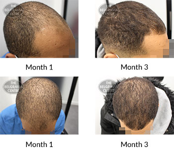 alert male pattern hair loss the belgravia centre 407008 19 01 2021