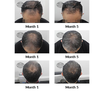 alert male pattern hair loss the belgravia centre 413556 20 04 2021