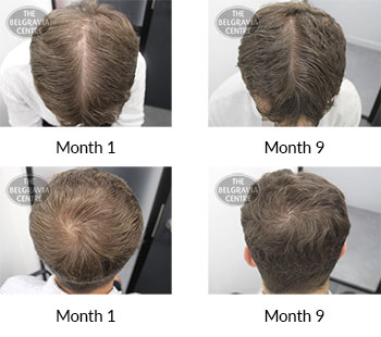 alert male pattern hair loss the belgravia centre 371563 21 04 2021