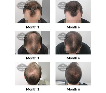 alert male pattern hair loss the belgravia centre 409456 28 04 2021
