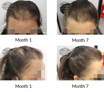 alert female pattern hair loss the belgravia centre 407989 30 04 2021 1
