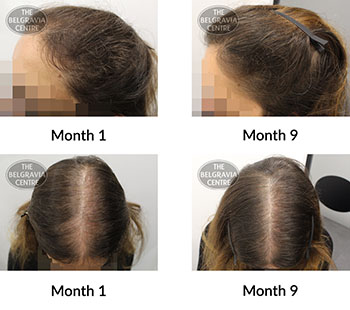 alert female pattern hair loss the belgravia centre 406141 26 05 2021