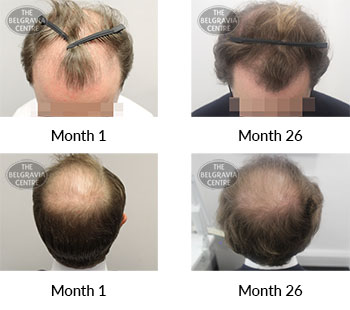alert male pattern hair loss the belgravia centre 381838 25 06 2021