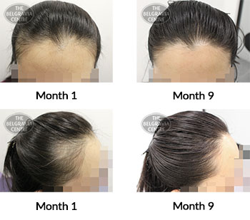 alert female pattern hair loss the belgravia centre 388813 01 07 2021