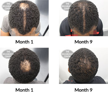alert male pattern hair loss the belgravia centre 411020 12 07 2021