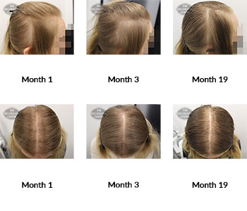 alert female pattern hair loss the belgravia centre 394399 13 07 2021