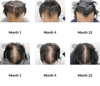 alert male pattern hair loss the belgravia centre 361013 13 07 2021