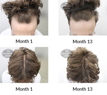 alert male pattern hair loss the belgravia centre 404533 21 07 2021