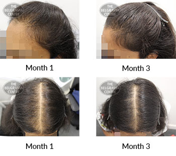 alert female pattern hair loss the belgravia centre 420201 21 07 2021