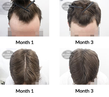 alert male pattern hair loss the belgravia centre 421877 03 08 2021