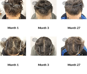 alert male pattern hair loss the belgravia centre 386105 04 08 2021