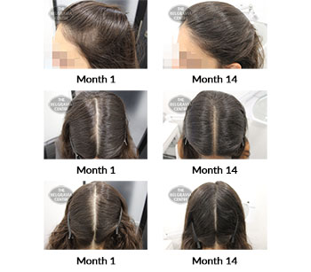 alert female pattern hair loss and diffuse hair loss the belgravia centre 403271 17 08 2021